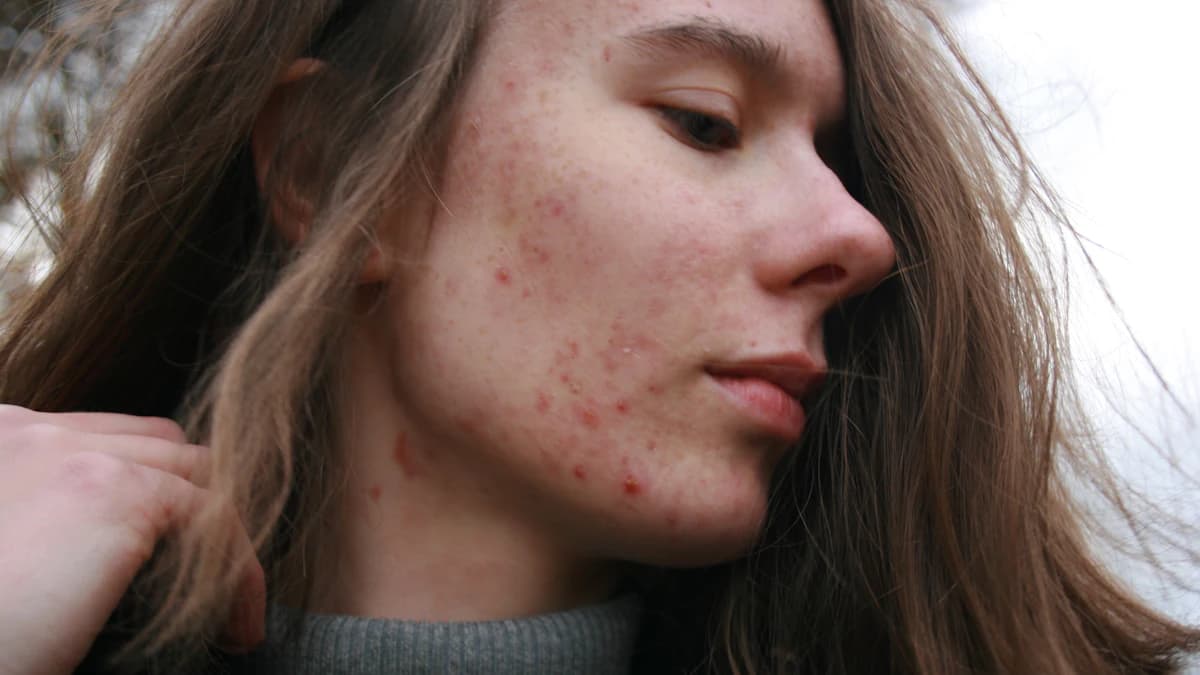 Acne littekens bespreken met huidtherapeut en behandelopties vergelijken